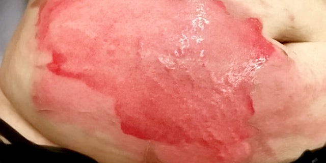The hot water bottle burst open while in between her legs, scorching her legs and stomach.