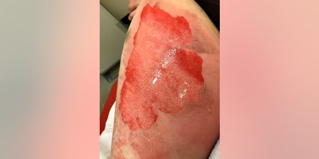 She said that by the time she got to the hospital she had developed massive blisters on her thighs and stomach.