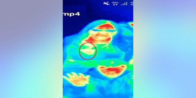 Bal Gill, 41, saw her a picture showed a red heat patch on her left breast.