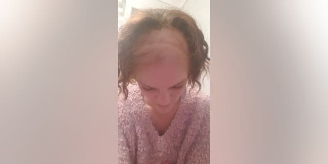 Cliare Curtis shows the scar caused by her brain surgery and her thinning hair due to chemotherapy treatments.