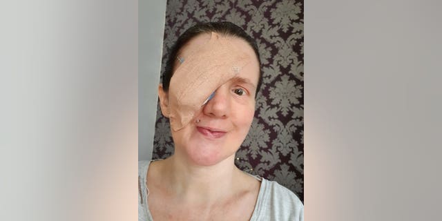 Claire Willis with her infected eye. (SWNS)