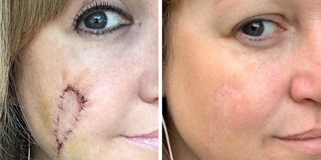 Natalie pictured before and after her scarring healed.