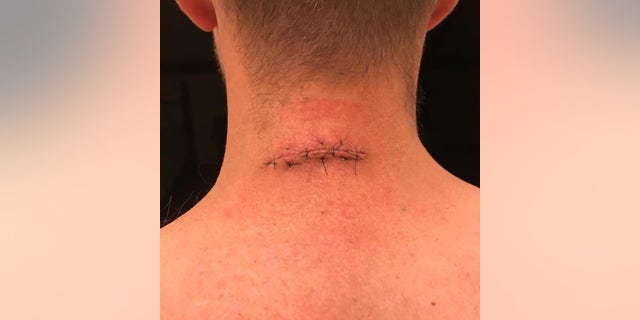 Ryan's neck after one of his initial surgeries.