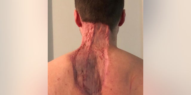 A large area of skin was removed from Ryan's back and neck.