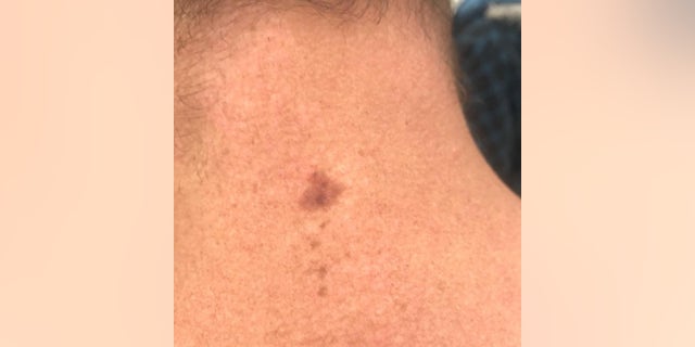 The spot on the back of Ryan's neck that was later determined to be cancerous.