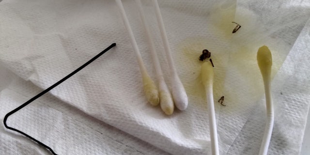 Liam Gomez put olive oil in his ear to relieve pain, but it actually worked to coax the spider out.
