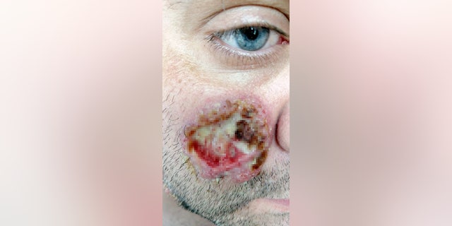 Young's ulcers are caused by pyoderma gangrenosum,