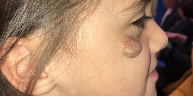 Four-year-old Laila McLatchie hopes to have the growth removed.