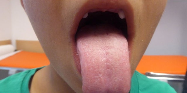 It took about two weeks for his tongue to heal after the ordeal.