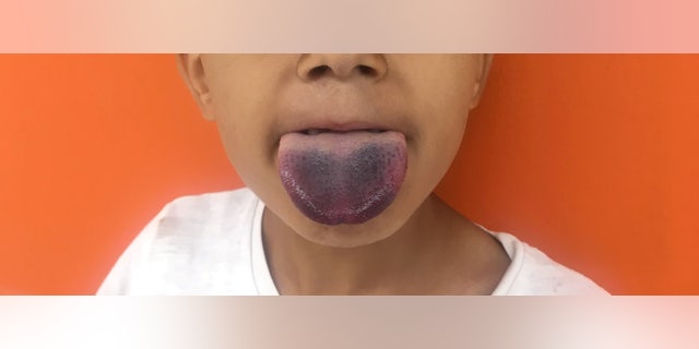 His tongue was freed, but he was kept in the hospital for further observation.