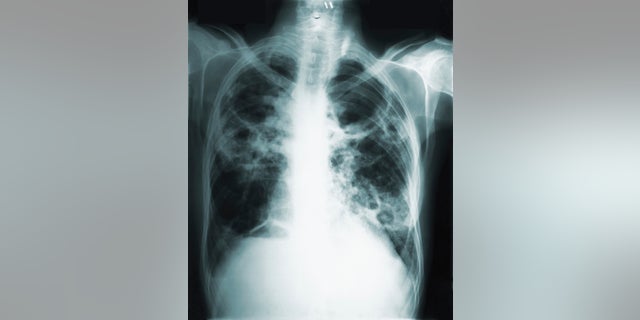 This 1966 image made available by the Centers of Disease Control and Prevention shows a chest x-ray of a tuberculosis patient.
