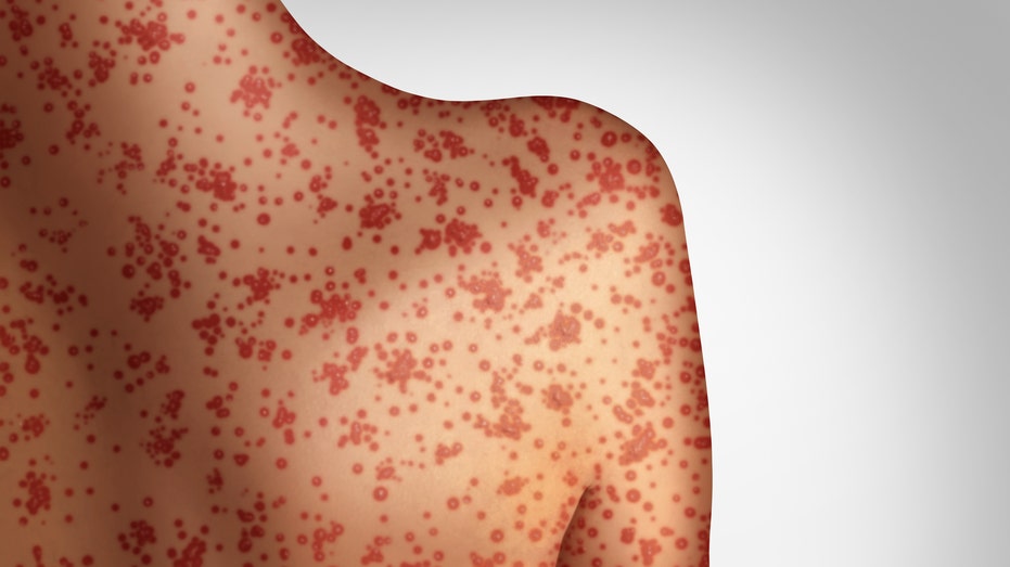 Traveler infected with confirmed case of measles at Seattle International Airport as cases in US increase
