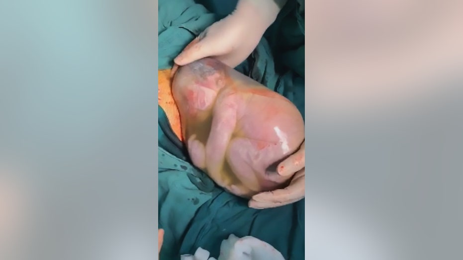 Baby born with amniotic sac intact, photos show | Fox News Baby born with amniotic sac intact, photos show | Fox News