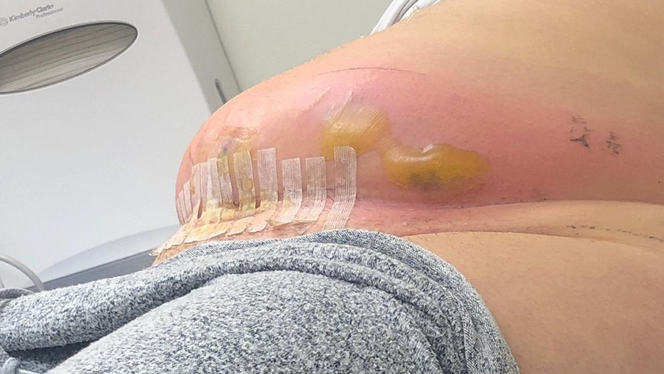 Mom claims C-section infection nearly killed her: 'It was eating ... Mom claims C-section infection nearly killed her: 'It was eating ...