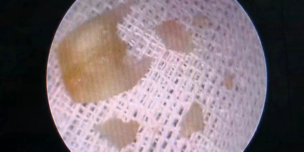 Man stuck garlic clove in ear in bid to get rid of infection, left it for 2 months, report says | Fox News Man stuck garlic clove in ear in bid to get rid of infection, left it for 2 months, report says | Fox News