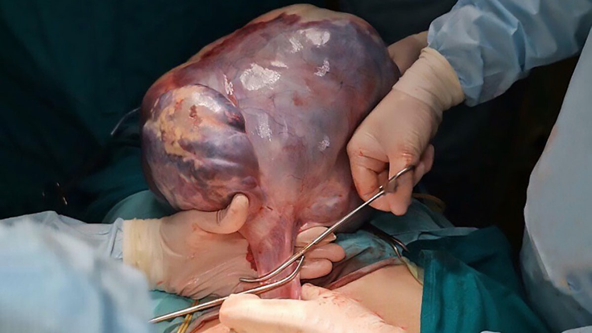 The 33-pound tumor had reportedly been growing in her abdomen for 20 years. 