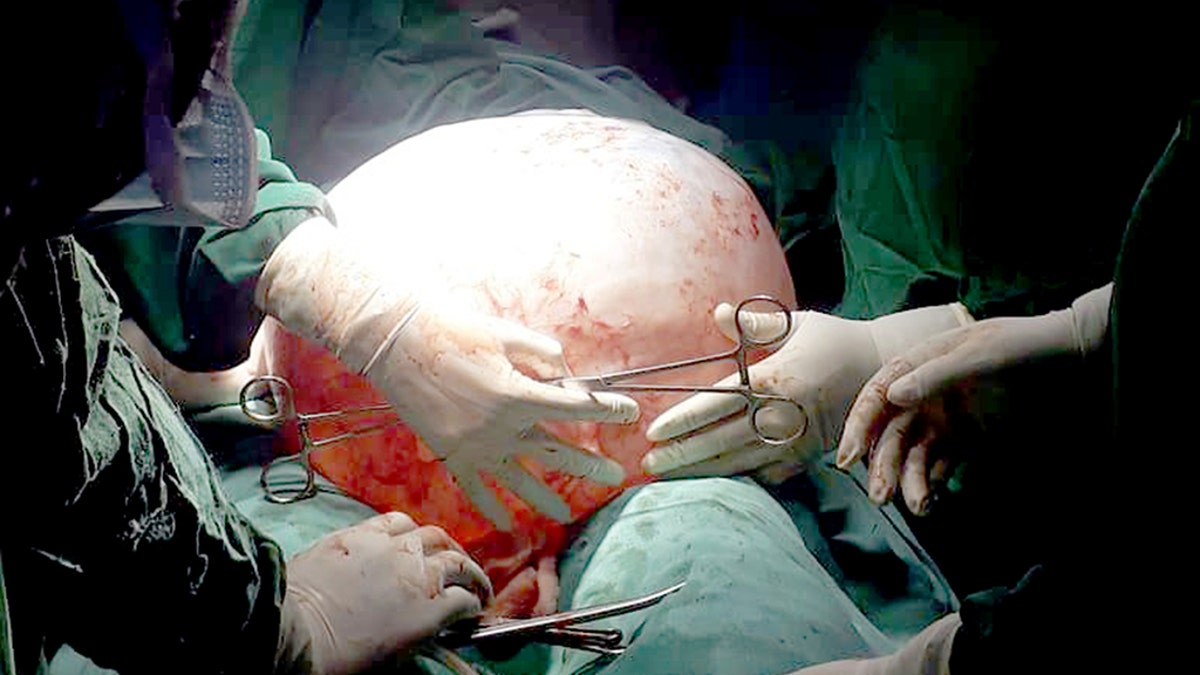 Surgeons worked to carefully remove the cyst through a 2-centimeter incision. 
