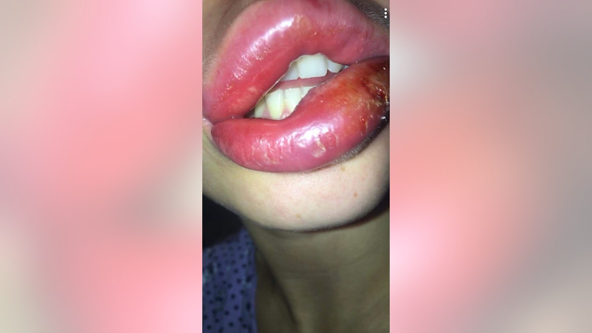 She said her lips swelled to three times the size within days. 