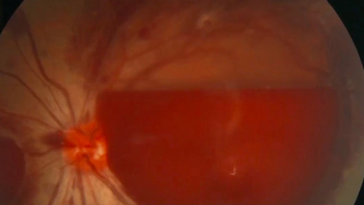 This image shows the burst blood vessel in the woman's eye following hours' worth of phone use.
