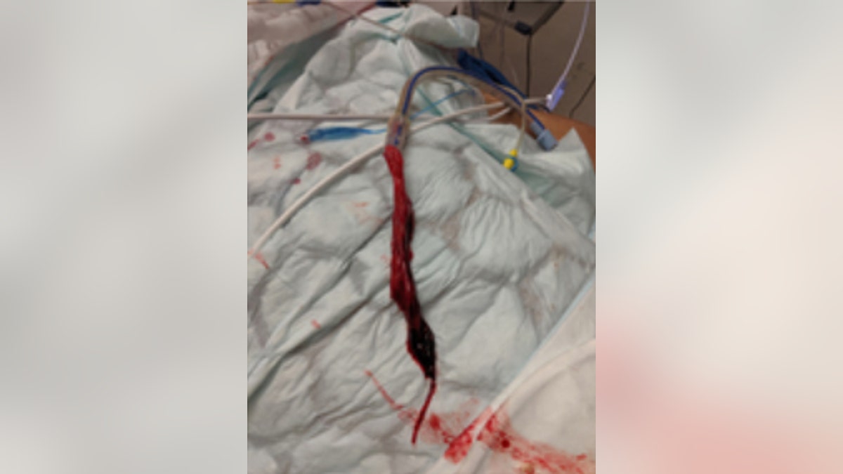 Doctors remove 8-inch blood clot in shape of bronchial tube from man's  chest