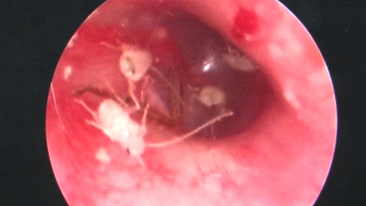 The man's ear canal was filled with newly hatched cockroaches.