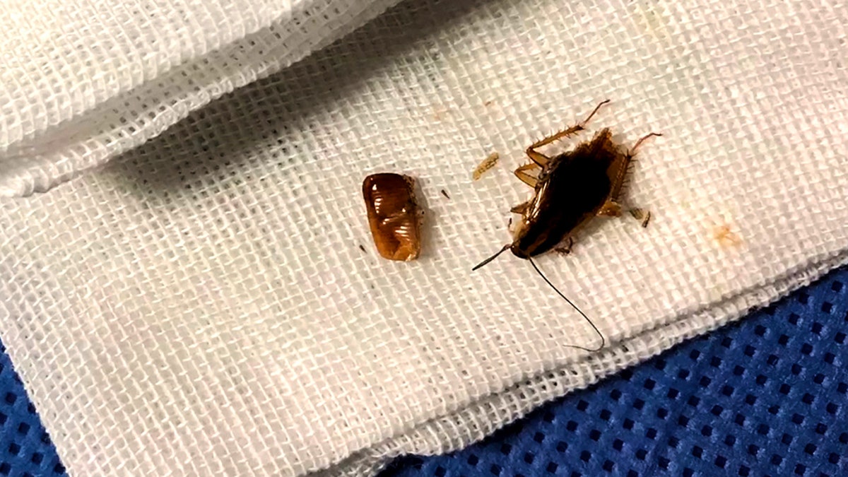 His doctor said the largest cockroach removed was the mother who had laid the eggs.