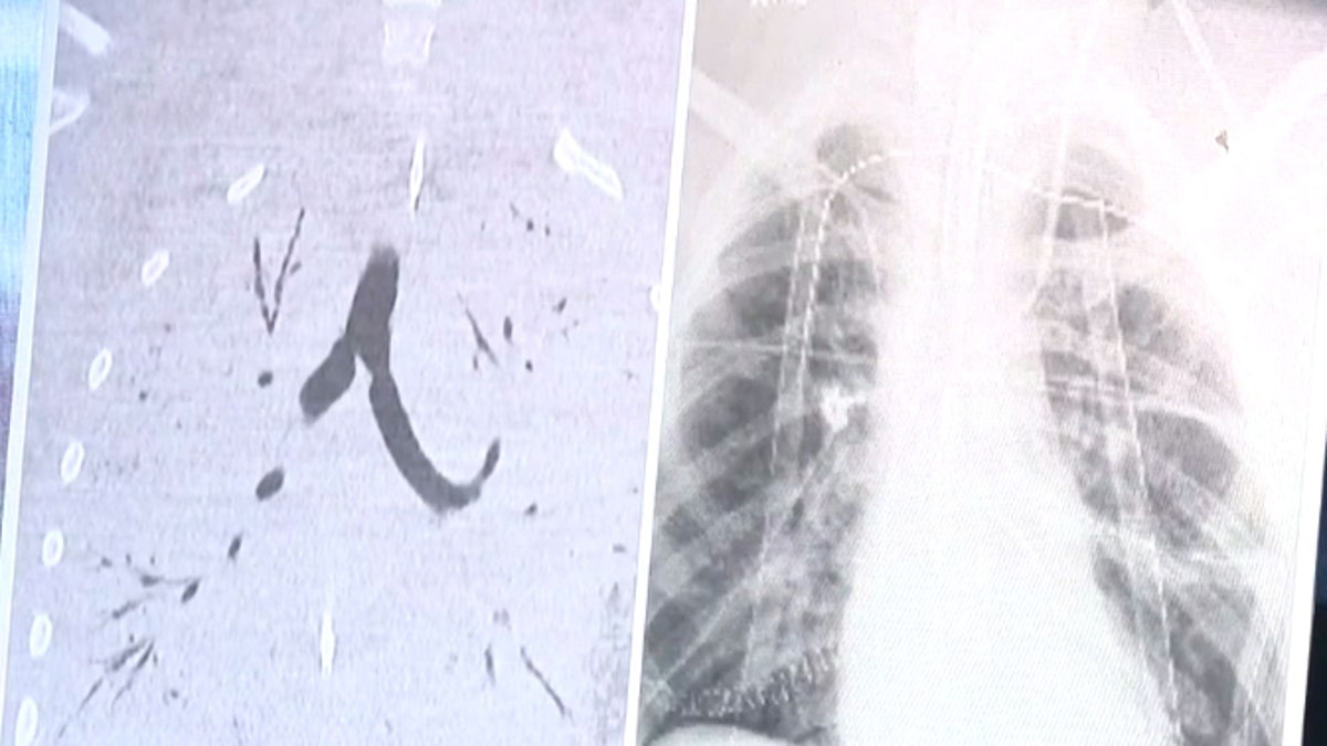 Pictured left are the teens severely damaged lungs filled with damaged tissue.