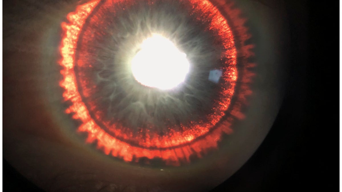 The man's eye appeared to "glow" because of a condition called pigment dispersion syndrome.