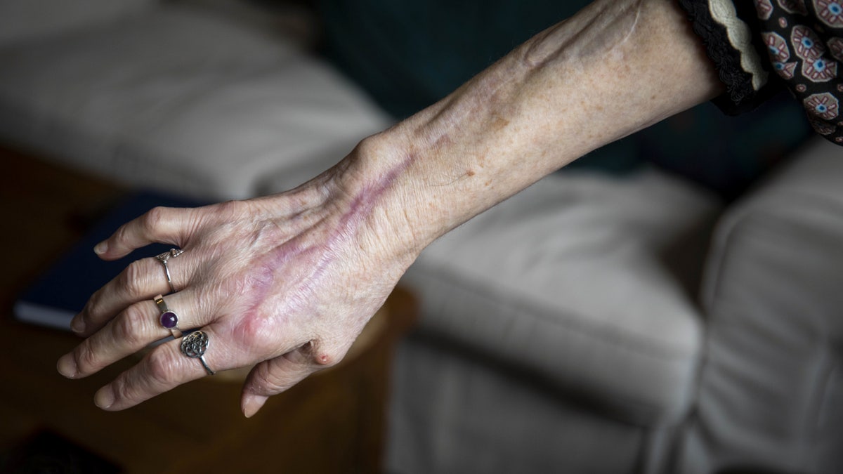 Shirley Hair shows the arm which was scratched by her cat causing a near fatal infection and remaining scarring.