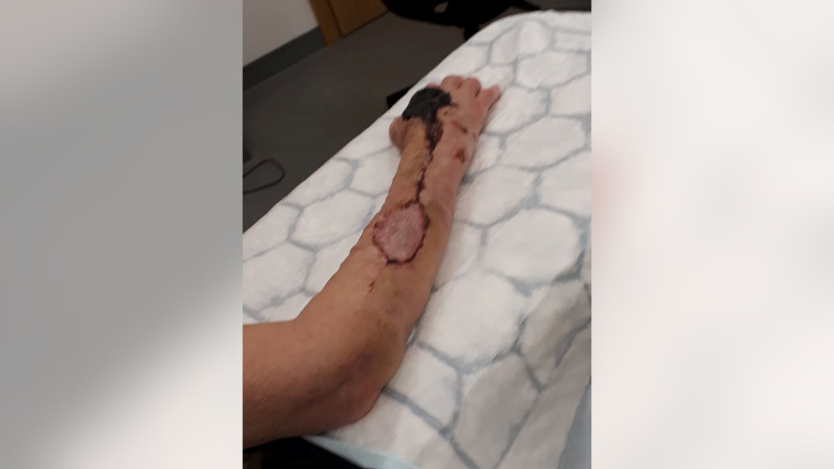 Shirley Hair's infected arm.