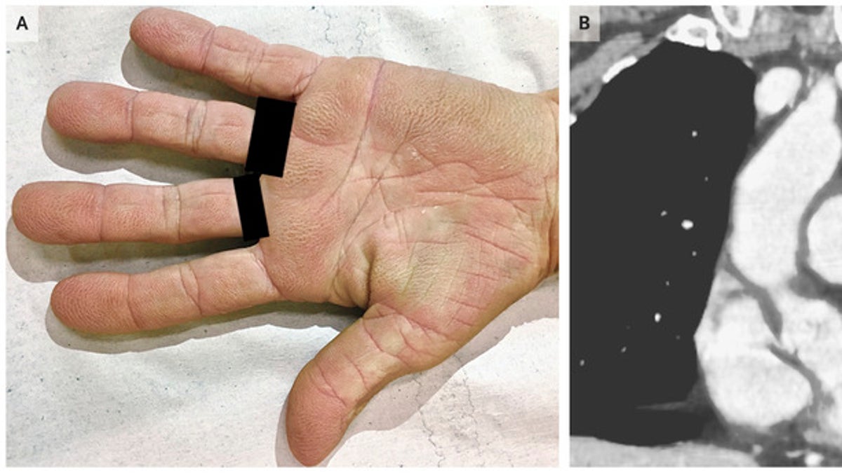 The woman's palms had a "velvety" appearance due to a rare condition linked to some cancers.