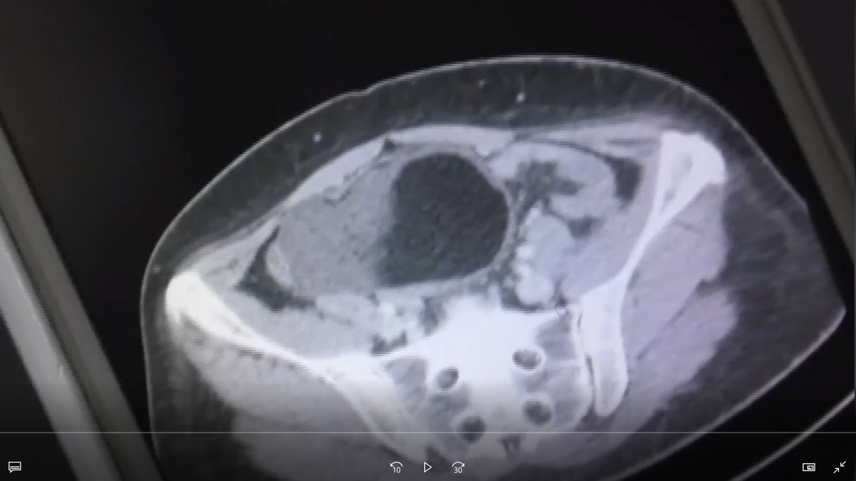 A scan of the woman's cyst.