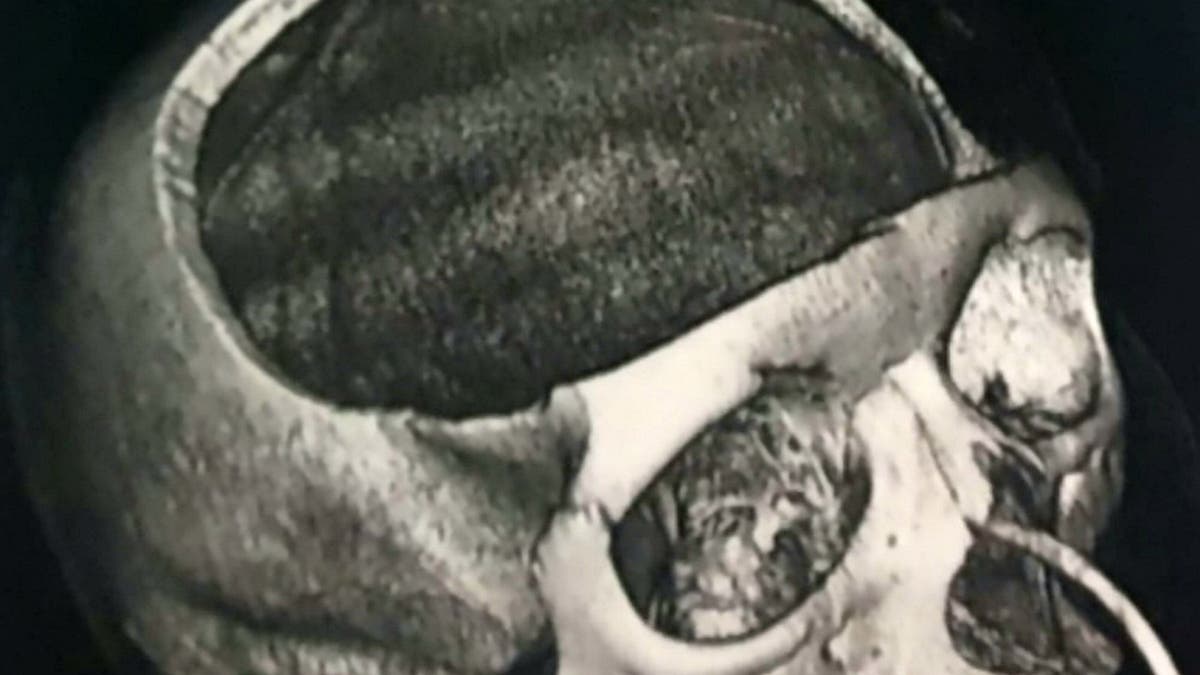 The 22-year-old had the front part of her skull removed following the scary incident. 