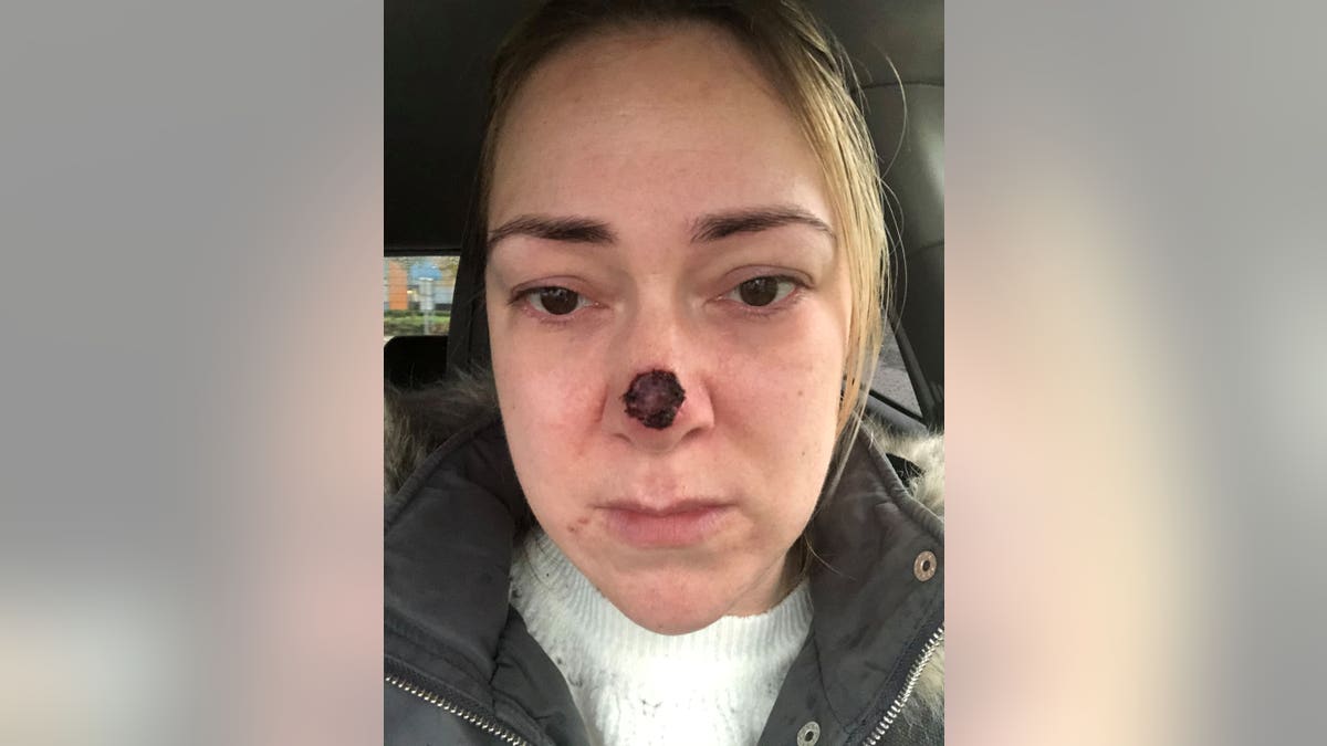 She had the sponge removed today, and said while her confidence has taken a hit she wants to share her story in a bid to warn others about the dangers of skin cancer.