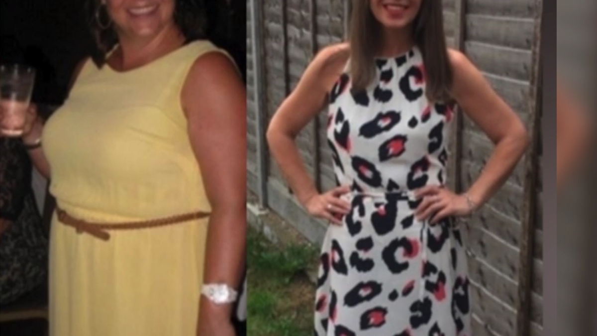 The 43-year-old mom claims the cyst caused her to lose 70 pounds because she was unable to eat properly.