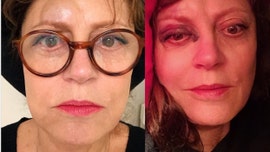 Susan Sarandon suffers concussion after dramatic fall, shares photos of other injuries