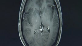 Man had hundreds of tapeworms in brain, chest after eating undercooked pork