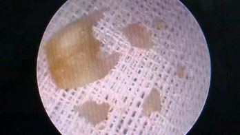 Man stuck garlic clove in ear in bid to get rid of infection, left it for 2 months, report says