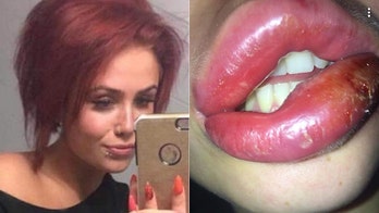 Woman claims cheap lip fillers left her with infected 'rock-solid sausages'