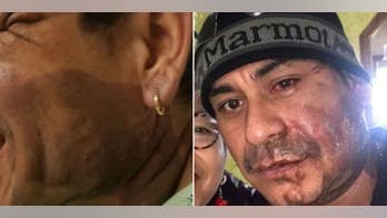 Milwaukee police arrest man in acid attack being investigated as hate crime