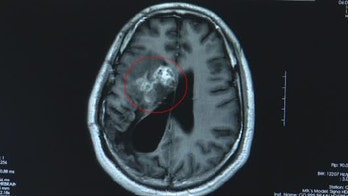 Man has 12-centimeter parasitic worm removed from brain after years of numbness, blackouts