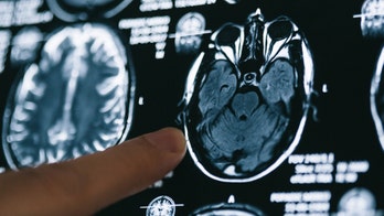 Woman seeking treatment for dizziness finds out she's missing her cerebellum