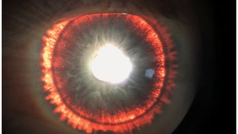 Rare syndrome causes man’s eye to 'glow'