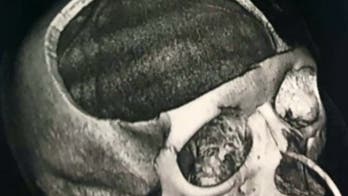 Surgeons remove chunk of woman's skull to reduce brain swelling after car runs red light, plows into her