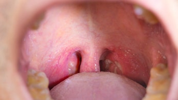 Do you need your tonsils removed?