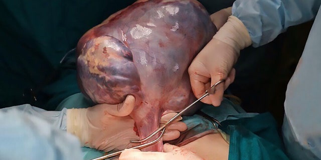 The 33-pound tumor had reportedly been growing in her abdomen for 20 years.
