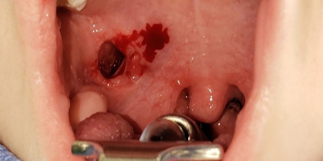 The hole had to be stitched up during emergency surgery at the hospital