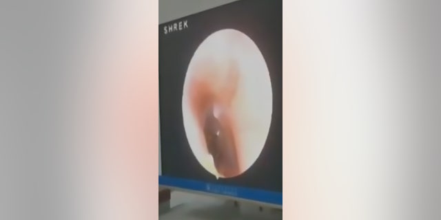 The 15-year-old had been complaining of itchiness in his ear before his father took him to the doctor.
