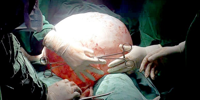 Surgeons worked to carefully remove the cyst through a 2-centimeter incision.
