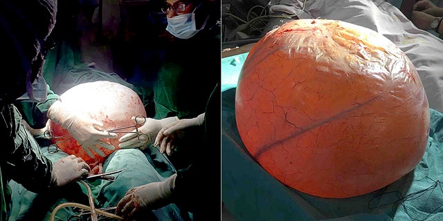 The cyst weighed 40 pounds and was the largest many at the hospital had ever seen.